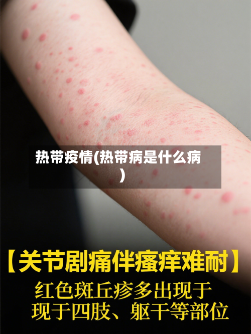 热带疫情(热带病是什么病)