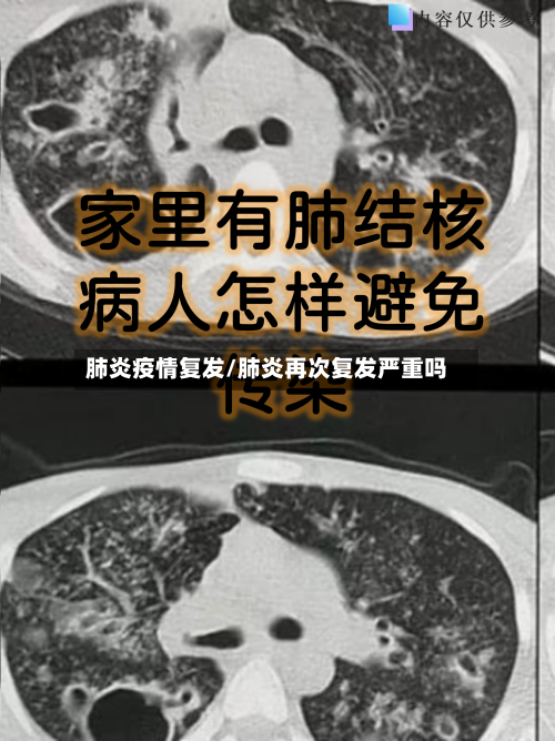 肺炎疫情复发/肺炎再次复发严重吗-第2张图片