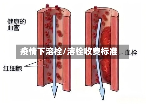 疫情下溶栓/溶栓收费标准
