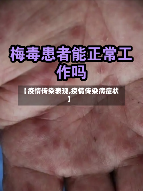 【疫情传染表现,疫情传染病症状】