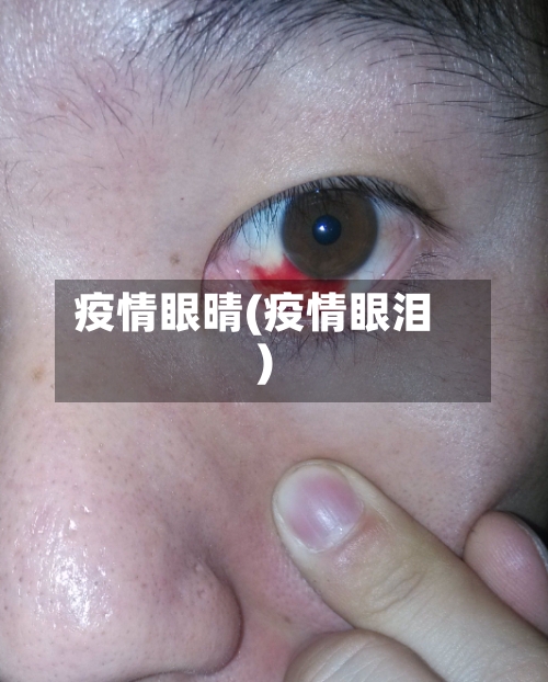疫情眼晴(疫情眼泪)