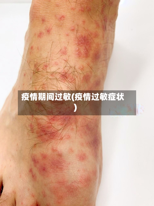 疫情期间过敏(疫情过敏症状)