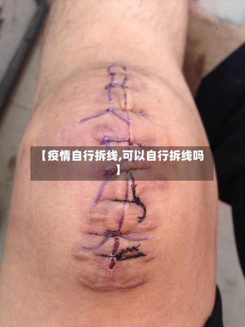 【疫情自行拆线,可以自行拆线吗】-第3张图片