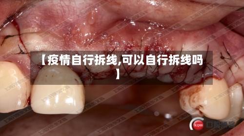 【疫情自行拆线,可以自行拆线吗】