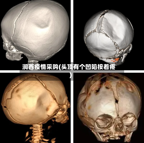 涧西疫情采购(头顶有个凹陷按着疼)