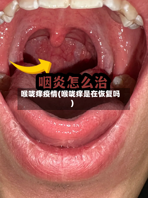 喉咙痒疫情(喉咙痒是在恢复吗)-第2张图片